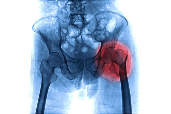 Hip Fracture