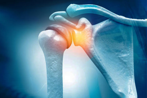 Shoulder Replacement