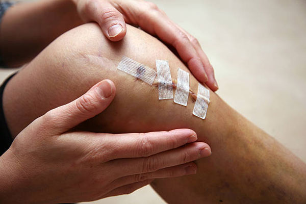Surgical Reconstruction of ACL